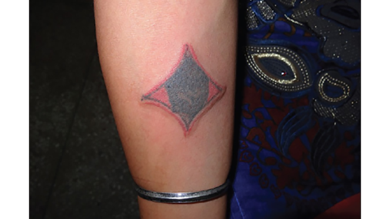 Why Is My Tattoo Itchy? Causes and Relief Tips