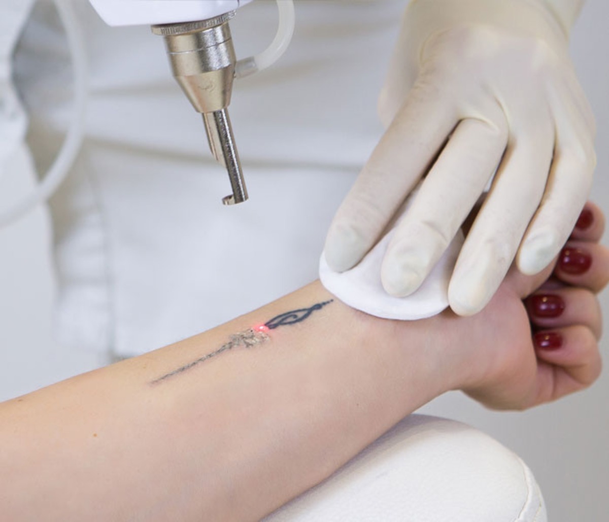Does Tattoo Removal Hurt? Pain Levels and Relief Tips Does Tattoo Removal Hurt? Pain Levels and Relief Tips