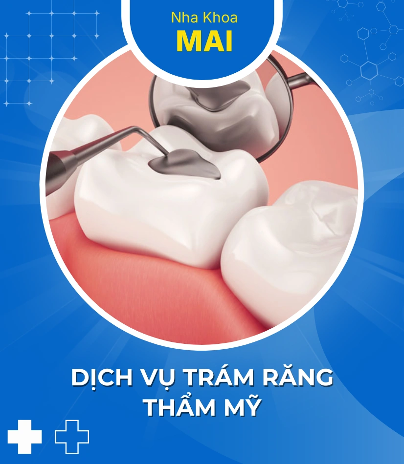 Dịch vụ trám răng thẩm mỹ