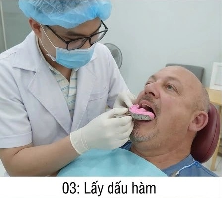 quy-trinh-rang-gia-thao-lap3
